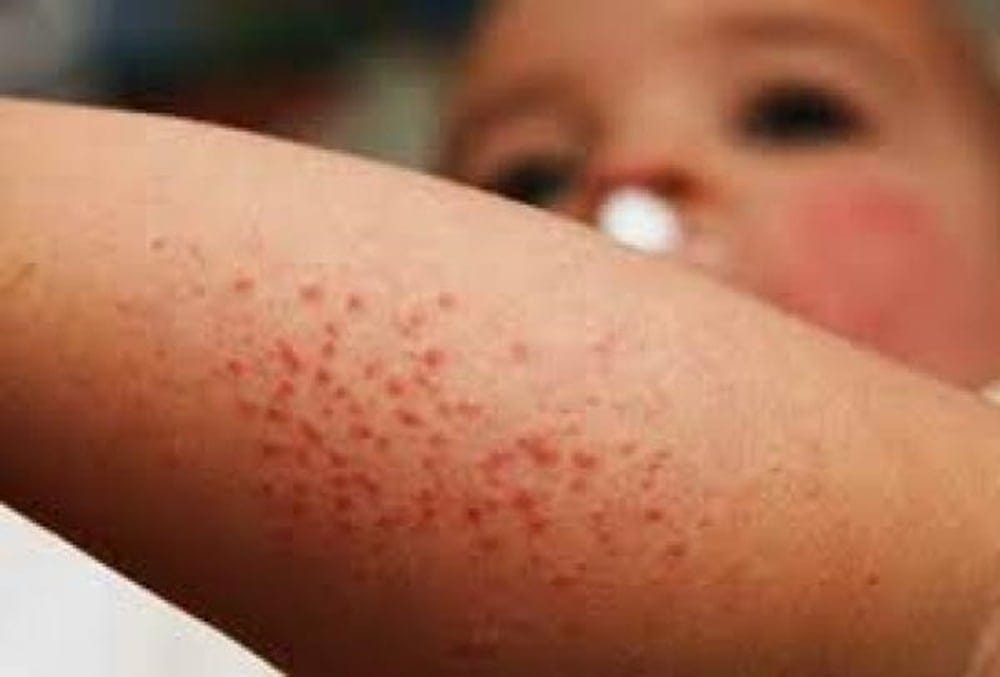 El sarampión se abre paso desde el sur de Venezuela y contagia a Brasil, Colombia y Ecuador