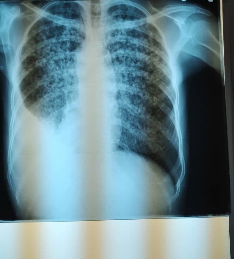 tratarse la covid-19