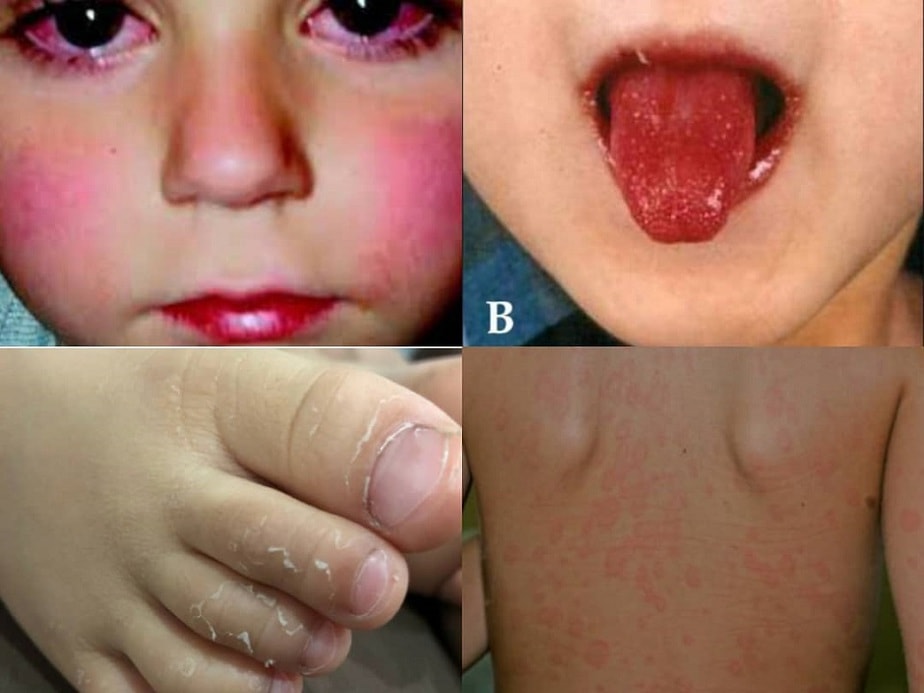 Alteraciones coronarias son la principal repercusión del síndrome de Kawasaki en niños